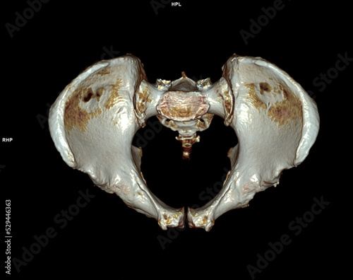 CT scan of Pelvic bone and hip joint 3D