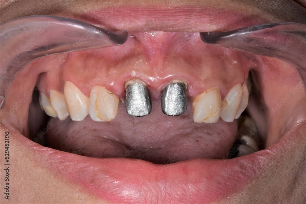 Two metallic post and core reconstructions cemented in the central