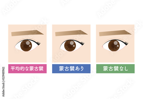 美容整形　蒙古襞の状態