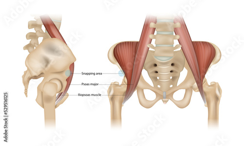 Internal snapping hip Syndrome. Psoas major, Iliopsoas muscle and Snapping area. Vector photo