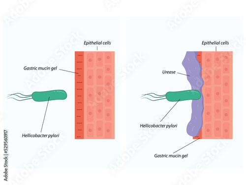 Invasion of Helicobacter pylori into the tissues of the stomach