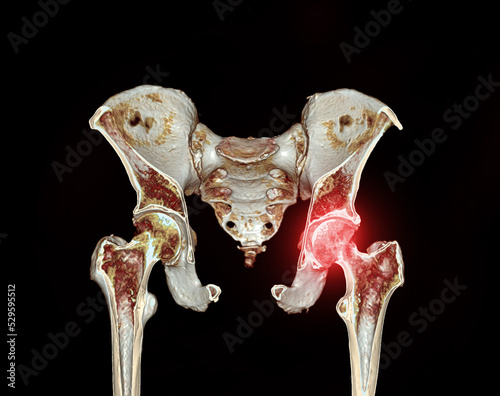 Valokuva CT scan of Pelvic bone and hip joint 3D rendering for diagnosis fracture of Pelvic bone and hip joint isolated on black background