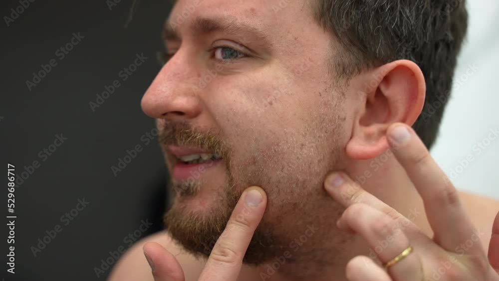 Man showing his irritated face skin with fingers, person suffering from cheeks irritation after daily shaving with sharp razor or electric trimmer. Problem of sensitive skin after shaving, male skin Man showing his irritated face skin with fingers, person suffering from cheeks irritation after daily shaving with sharp razor or electric trimmer. Problem of sensitive skin after shaving, male skin