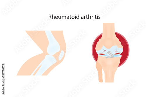 Inflammatory rheumatism, or rheumatoid arthritis, is a chronic inflammatory disorder.