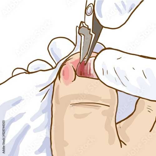 cartoon treatment of ingrown toenails photo