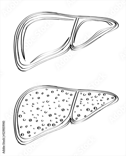 Liver Cirrhosis disease