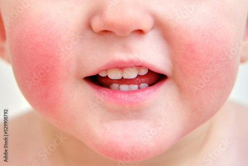 Portrait of a child with allergies on the cheeks and chin. Toddler baby boy with allergies on red face skin, white background