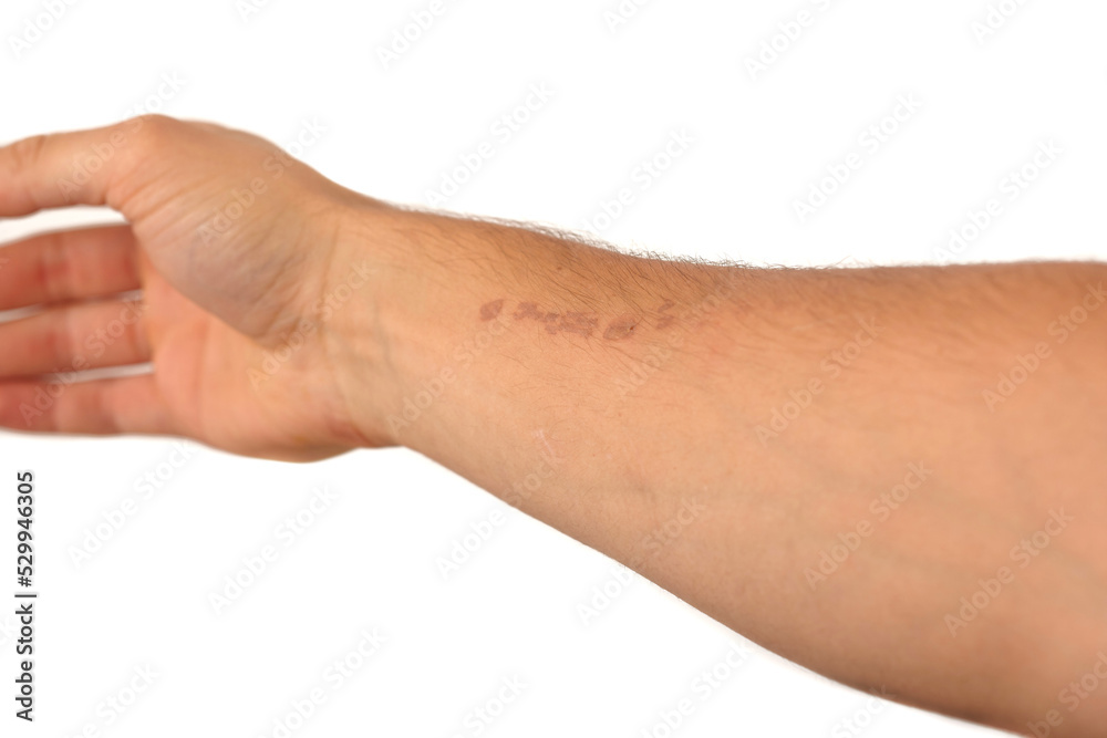 Light burn wound injury from a chainsaw chain