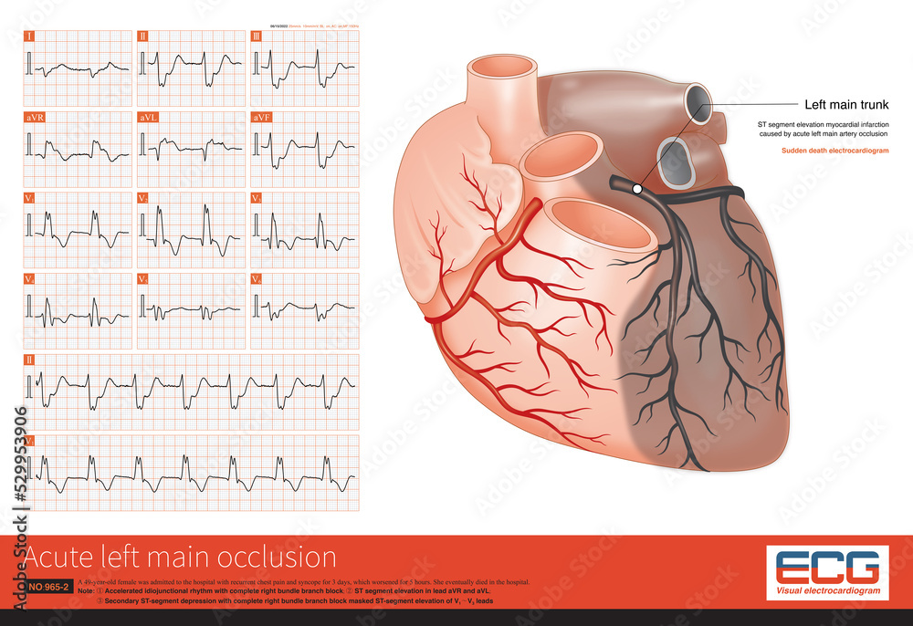 The coronary angiography showed complete occlusion of the left main