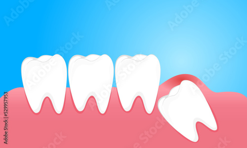 Wisdom teeth cause pain to the gums