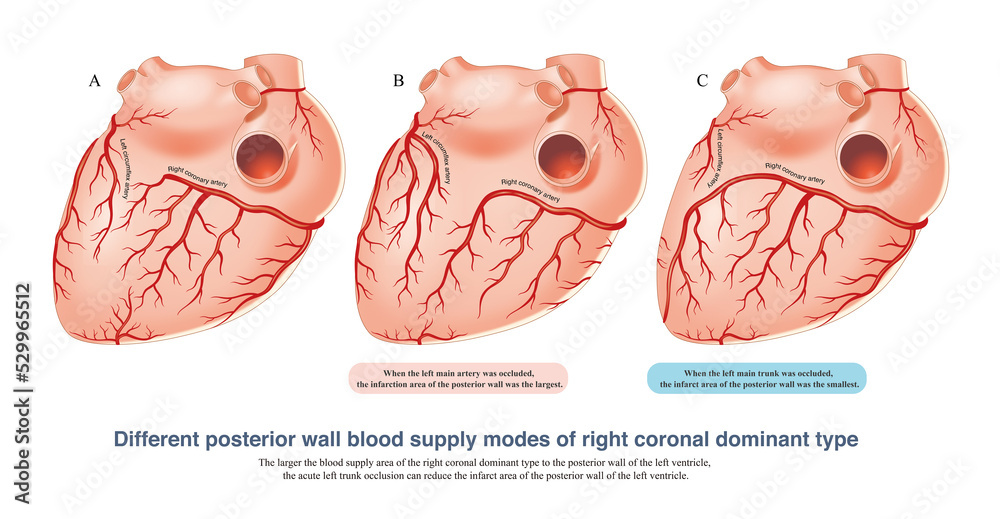 The larger the blood supply area of the right coronal dominant type to
