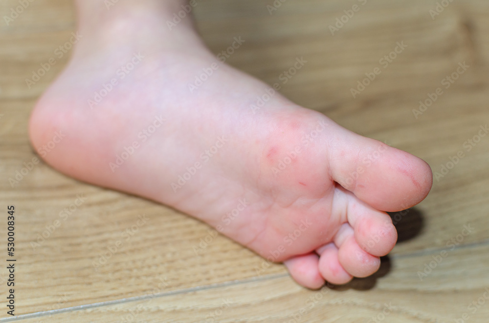 Enterovirus Feet Rash on the body of a child. Cocksackie virus rash