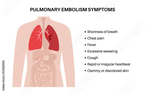 Pulmonary embolism disease