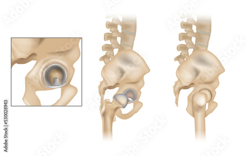 Anatomy of the Hip and Acetabular Labrum. Ligamentum teres and Articular cartilage. Lateral view with femur removed of right hip. photo