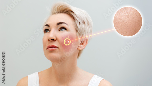 Portrait of an adult Caucasian blonde woman with redness on her cheeks. Laser removes couperose showing the result with healthy skin. The concept of rosacea and hypersensitive skin photo