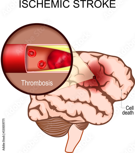 ischemic stroke. Human brain. Close-up of a blood clot in an artery