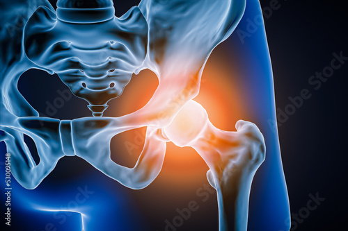 Anterior or front view of human hip joint and bones with inflammation or injury 3D rendering illustration. Pathology, articular pain, anatomy, osteology, rheumatism, medical and healthcare concept.