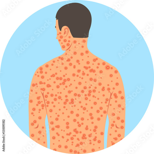 Red rash on the human body.