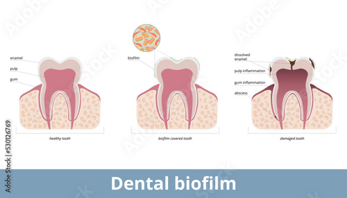 Dental biofilm. Biofilm covers teeth and causes enamel desolvation, inflammation of a gum and pulp. Biofilm on a tooth damages dental tissues, provokes abscess formation.