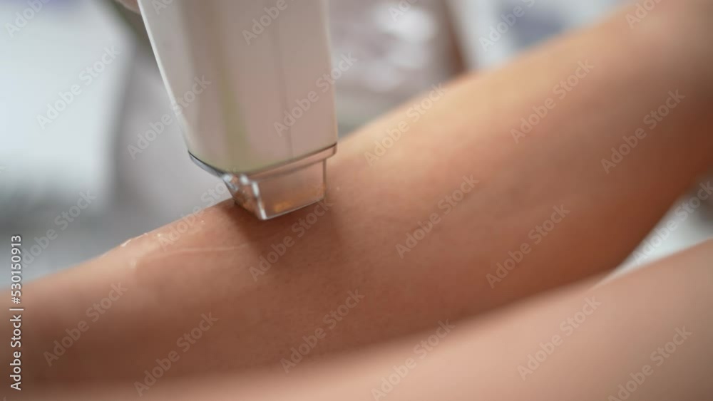 Close up flash of diode laser hair removal on legs. Woman getting laser hair removal procedure on her legs. Hair removal for smooth skin. Laser procedure at beauty studio or clinic.4k footage