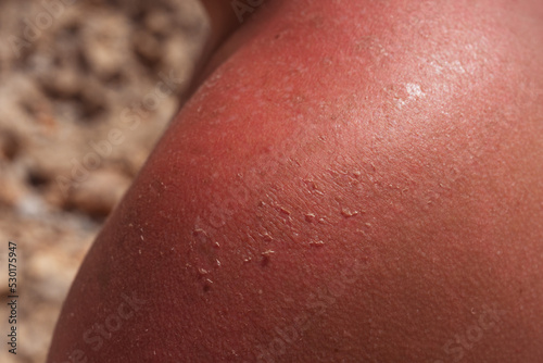 sunburn on the skin of a man. swollen skin from blisters on the boy's shoulder. red skin he has an overabundance of sun. sunburn at a dangerous hour