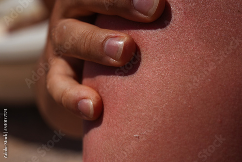 sunburn on the skin of a man. swollen skin from blisters on the boy's shoulder. red skin he has an overabundance of sun. sunburn at a dangerous hour