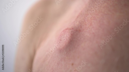 An elderly man has a catheter under the skin for chemotherapy. Close-up of a catheter on a man's neck.