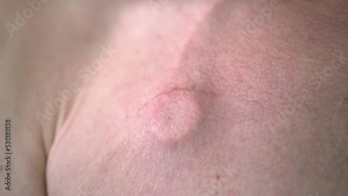 Close-up of a catheter under the skin. An elderly man has a chemotherapy catheter in his neck.