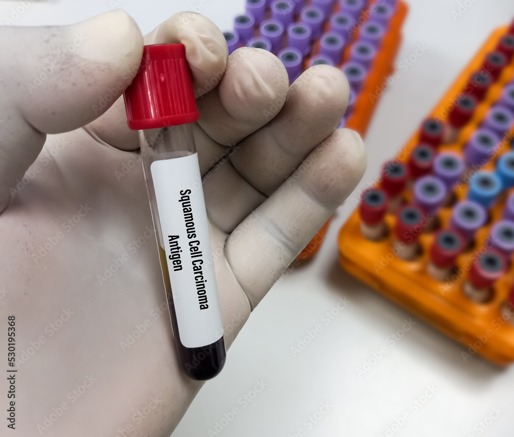 Squamous cell carcinoma antigen or SCCA testing for the diagnosis of