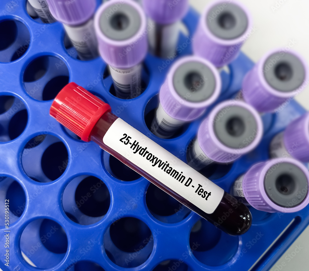 Blood sample for 25hydroxyvitamin D test, It's converts from vitamin D