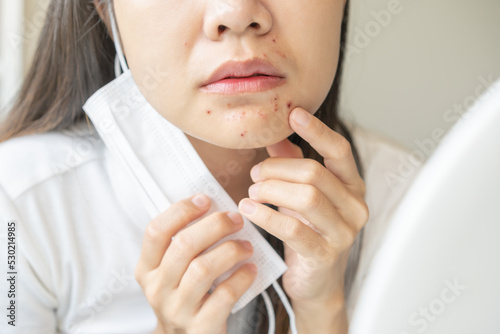 Expression worry asian young woman hand touching pustule around the chin and mouth, allergic when wear mask, makeup, show squeezing pimple spot from face. Beauty care, skin problem by acne treatment. photo