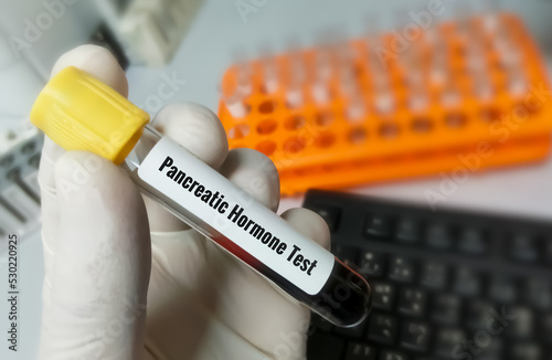 Blood sample for Pancreatic Hormone test.