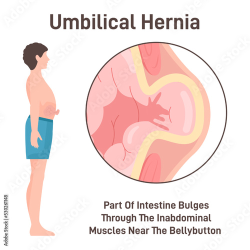Umbilical hernia. Part of the intestine bulges through the opening