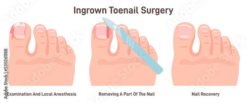 Feet with ingrown toenail. Nail inflammation with pus and blood.