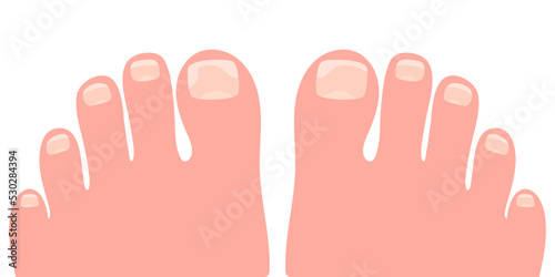 Bare foots with onycholysis on a toenails cartoon vector illustration. Fungal toenail infection photo