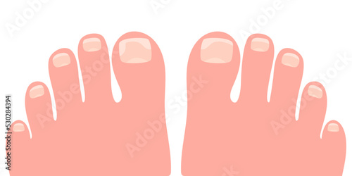 Bare foots with onycholysis on a toenails cartoon vector illustration. Fungal toenail infection
