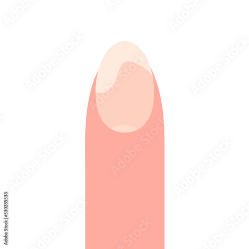 Onycholysis with a damaged nail cartoon vector illustration. Partial exfoliation of the nail from the nail bed. 