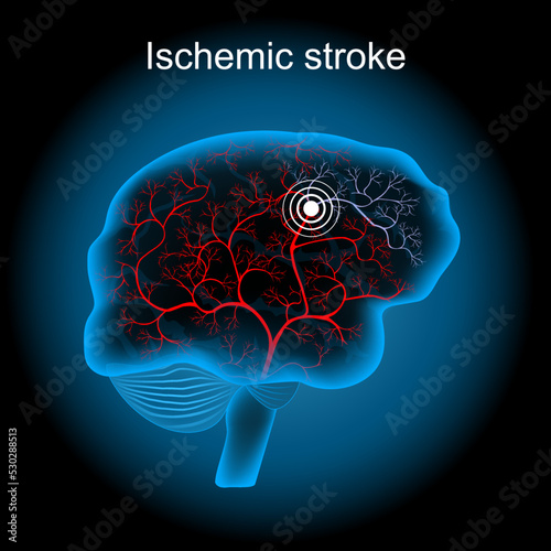 Cerebral infarction. ischemic stroke. human brain