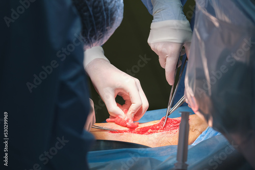 Closeup of doctors hands operating a patient conducting open cut surgery in surgical room. Healthcare and medical intervention concept