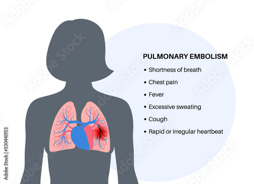 Pulmonary embolism disease