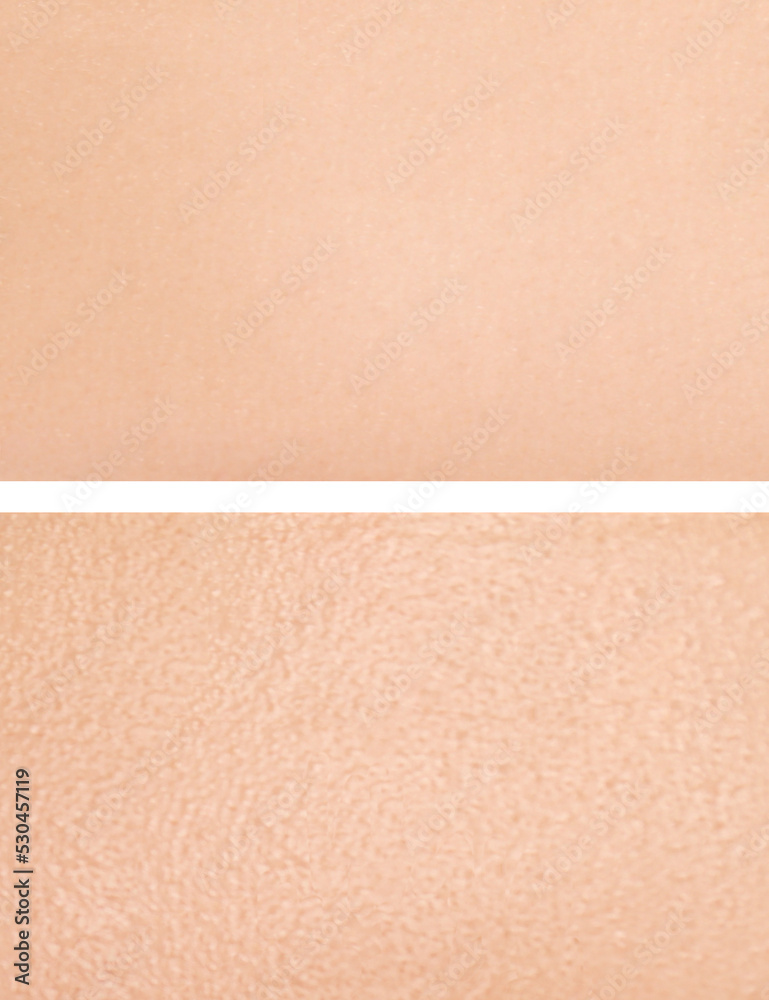 Fototapeta premium Collage with photos of dry and moisturized skin texture