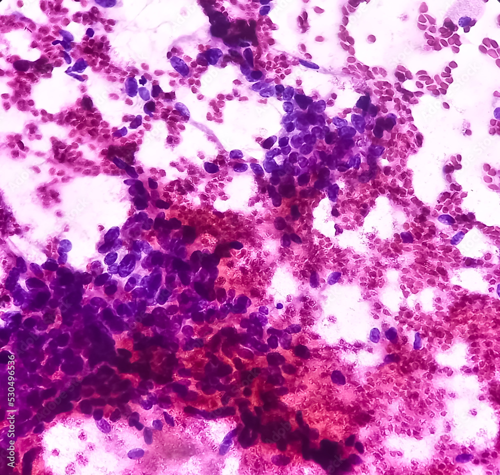 Cytological study of knee joint swelling Spindle cell neoplasm, smear