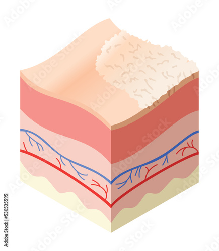 Skincare medical concept. Problems in cross-section of human skin horizontal layers structure. Anatomy illustrative model unhealthly layer of skin