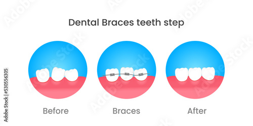 Orthodontic steps before and after orthodontics