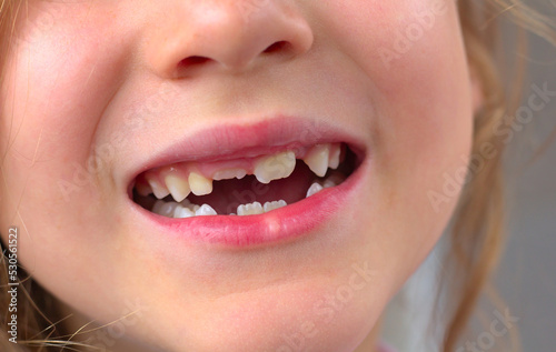 A close-up of the smile of a little girl without milk teeth  with growing permanent teeth.