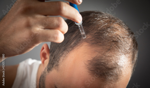 Man applying dropper vitamin on head. Baldness treatment concept