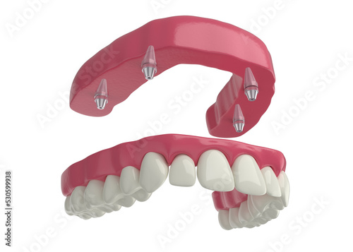 dental prosthesis, 4 overdenture implants, upper arch, 3d render
