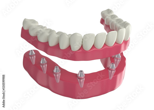 dental prosthesis, 8 overdenture implants, lower arch, 3d render photo