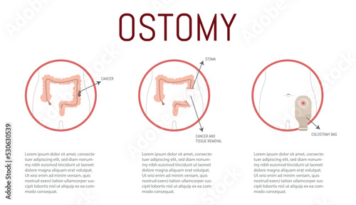 Ostomy process in case of cancer, once detected, it is sectioned and the bag is placed. photo