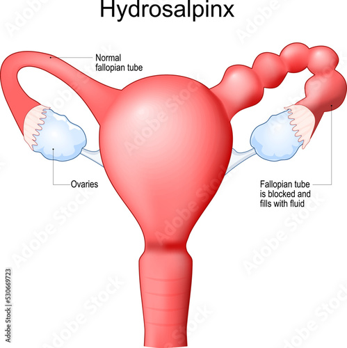 Hydrosalpinx. Human uterus with blocked of Fallopian tube.